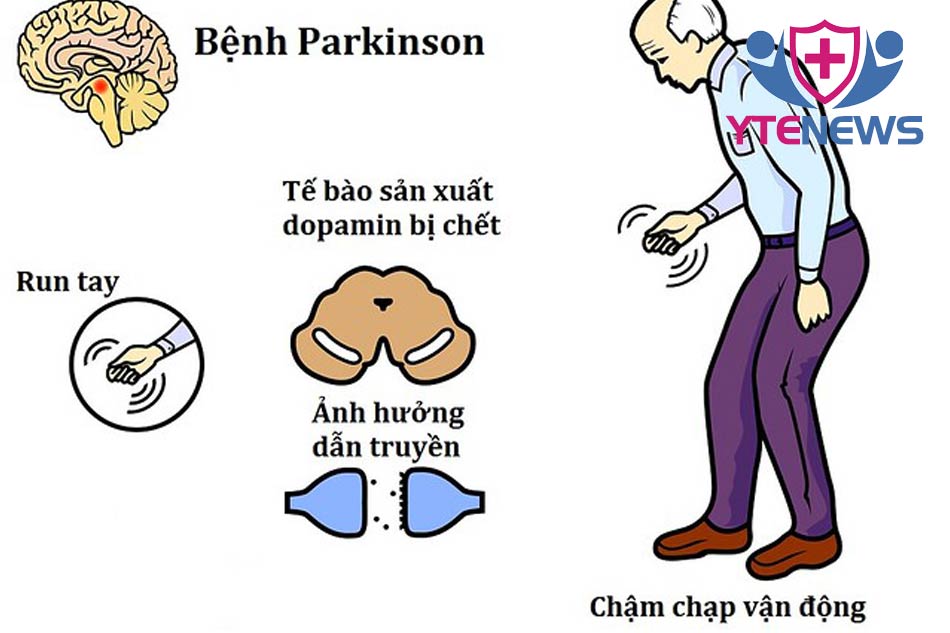 Những triệu chứng của bệnh Parkinson