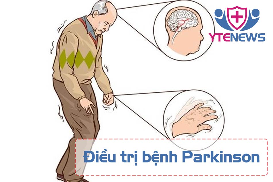 Phương pháp điều trị bệnh Parkinson