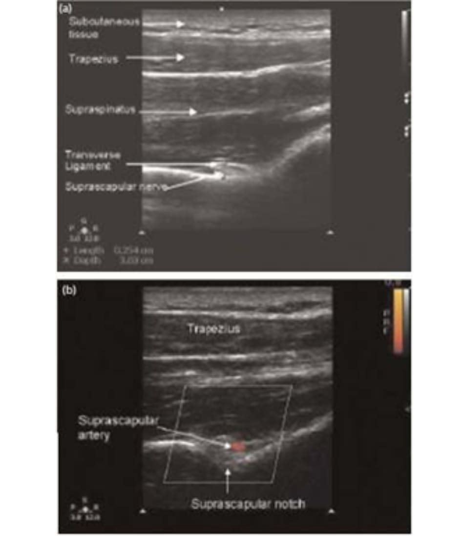 Hình 11.2 a) Hình ảnh siêu âm khuyết (trên) vai và các thành phần xung quanh. (b) Doppler màu cho thấy động mạch trên vai. (Sao chép, với sự cho phép của USRA, www.usra.ca).