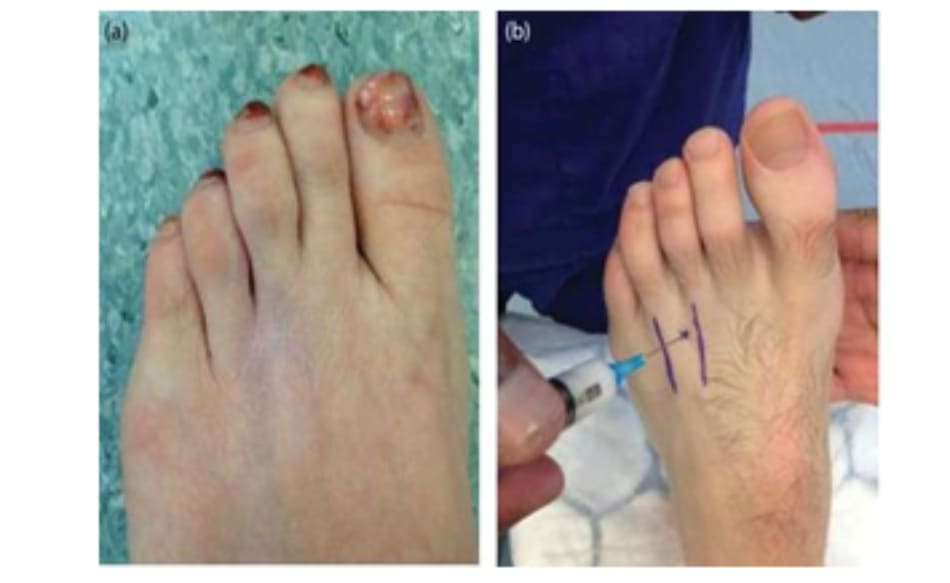 Hình 5.4 (a) Giảm sắc tố da sau khi tiêm. (b) Cách tiếp cận từ mặt mu chân để tiêm thuốc điều trị u thần kinh Morton, các gân duỗi được đánh dấu bằng mực.