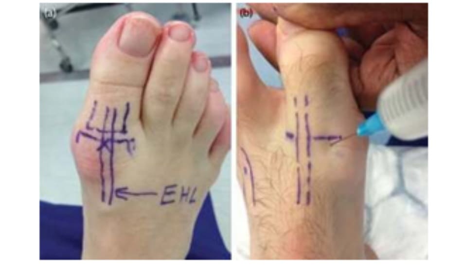 Hình 5.7 (a) Mốc giải phẫu khớp bàn ngón chân cái và (b) vị trí đặt kim.