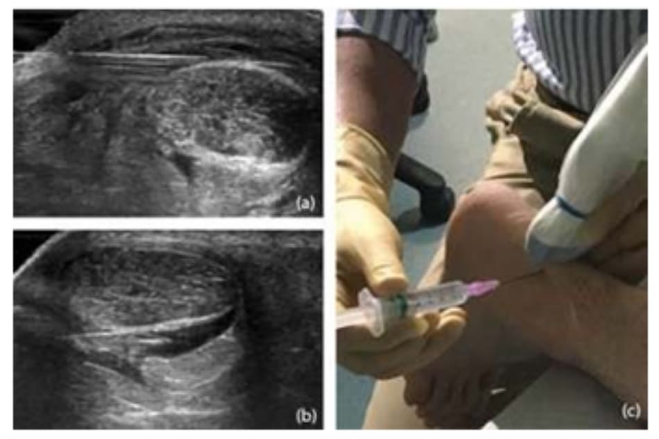 Hình 6.9 HVI gân Achilles (bệnh nhân khác với Hình 6.8). (a) Có thể nhìn thấy kim trên bề mặt của gân Achilles. (b) Kim cũng được đưa vào sâu (đến lõi gân Achil- les) để có thể tiếp cận toàn bộ tổ chức quanh gân. Lượng nước muối lớn gây ra sự phá vỡ mô sẹo và tân mạch(c) Đầu dò US được đặt vuông góc với gân Achilles và kim được đưa thẳng hàng với đầu dò đi vào da từ cách tiếp cận phía ngoài/bên.