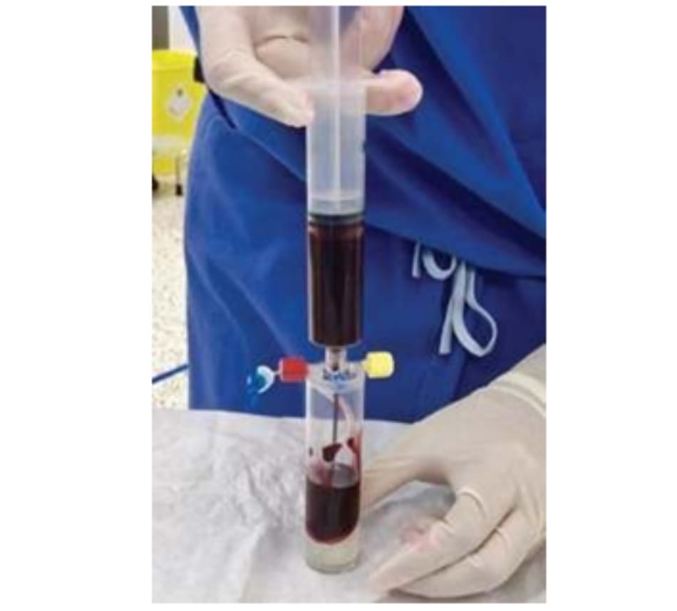 Hình 7.2 Tiếp theo, 55 mL máu của bệnh nhân với 5 mL chất chống đông máu được đưa vào ống phân tách.