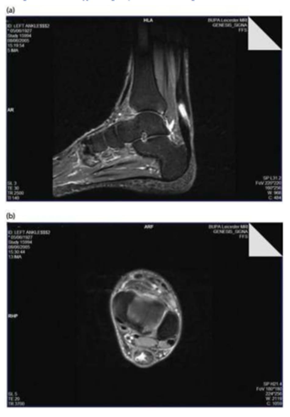 Hình 9.3 (a) Hình ảnh MRI của tay vợt nam 77 tuổi bị hoại tử lõi của gân Achil- les. (b) Lát cắt ngang.
