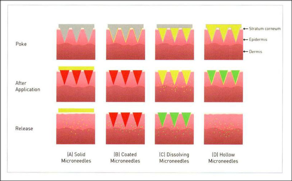 Hình 23-1 The drug delivery mechanism of (A) solid microneedle (solid IVIN), (B) coated microneedle (coated IMN), (C) dissolving microneedle (dissolving IVIN) and (D) hollow microneedle (hollow IMN)