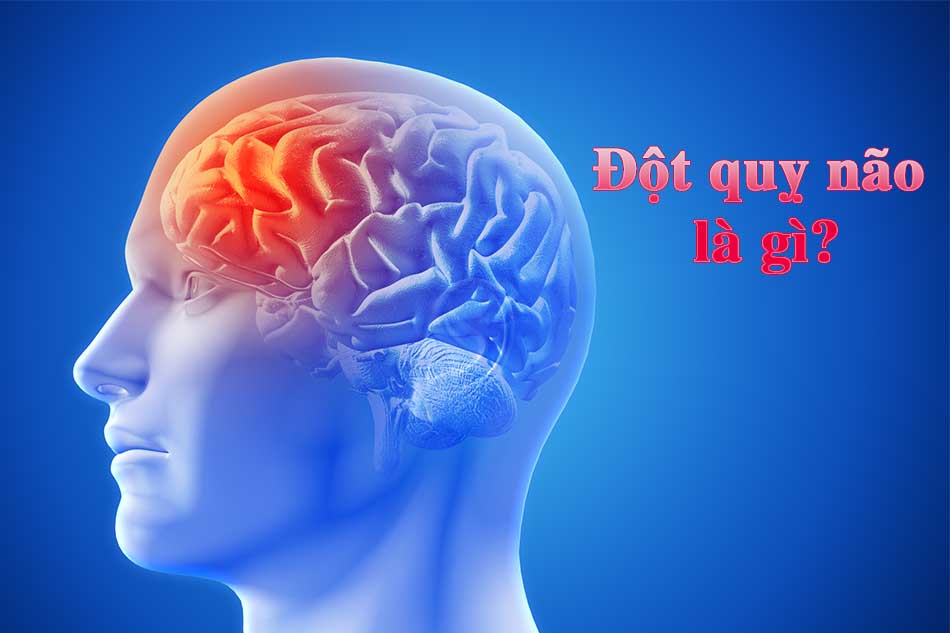 Đột quỵ não là gì?