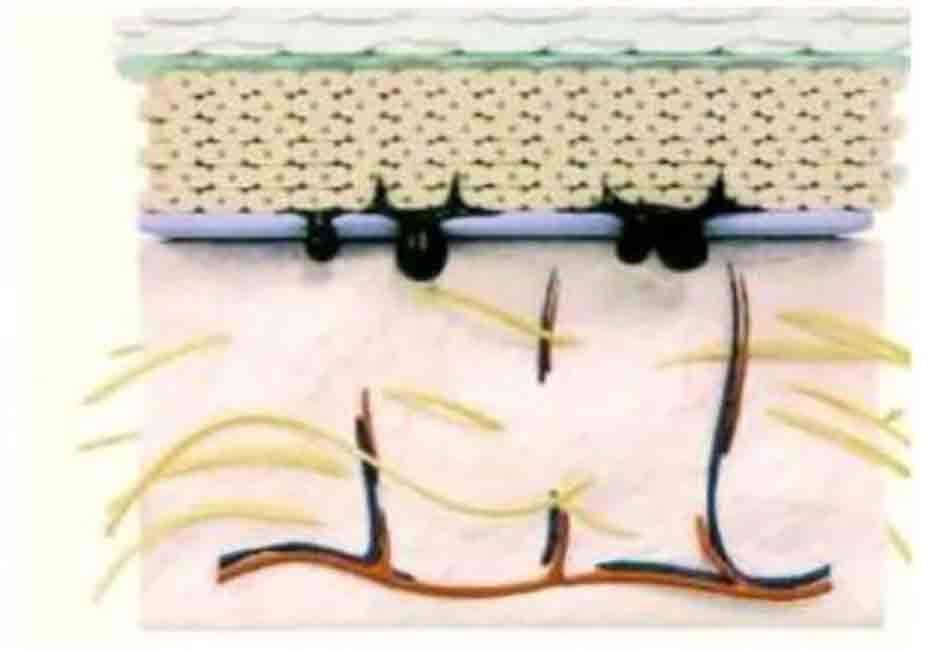 Hình 11-8 Hình ảnh minh họa khi màng đáy bị hư hại tế bào bình thành sừng và tế bào melanin bị đùn qua (protruded) lớp hạ,bì.