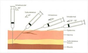 Hình 27-2 Phương pháp tiêm khác nhau ở vị trí thông thường