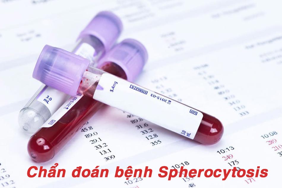 Chẩn đoán bệnh Spherocytosis