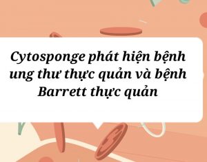 Cytosponge phát hiện bệnh ung thư thực quản và bệnh Barrett thực quản