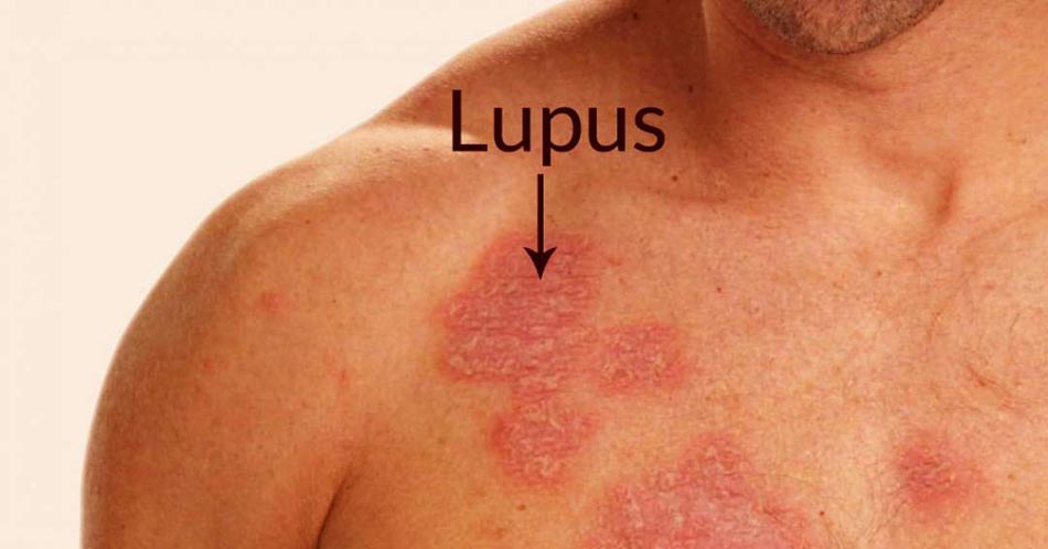 Lupus có thể gây nguy cơ tử vong cao hơn do nhiễm COVID-19.