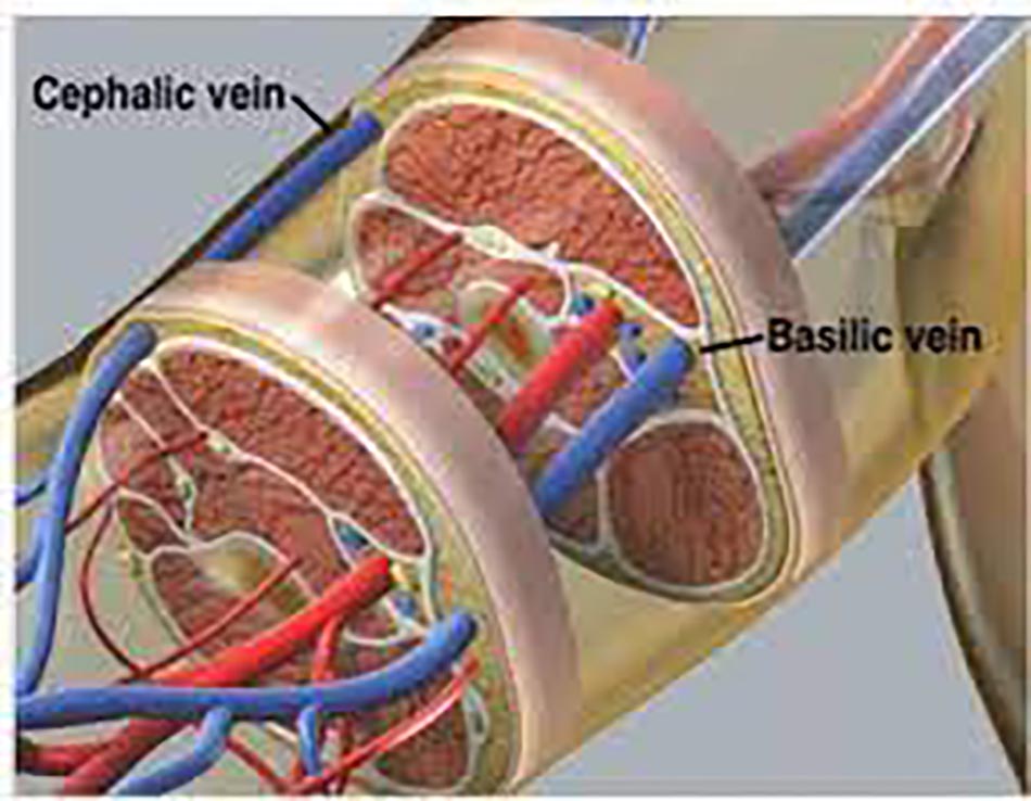 Thay thế catheter tĩnh mạch ngoại vi PVC
