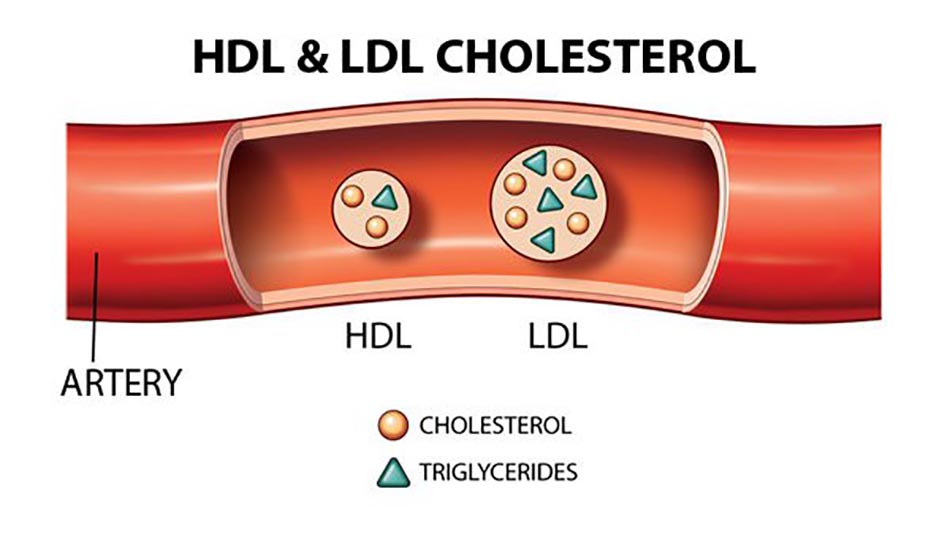 Phơi nhiễm lâu hơn với LDL tăng cao gắn với nguy cơ bệnh mạch mạch CHD cao hơn.