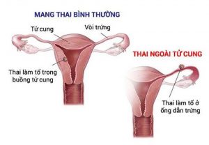 ĐẶC ĐIỂM LÂM SÀNG VÀ HÌNH ẢNH SIÊU ÂM QUA ĐƯỜNG ÂM ĐẠO CHỬA NGOÀI TỬ CUNG