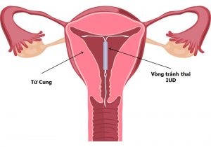 Các biện pháp tránh thai có thể tăng cường cải thiện nhu mô nền trên MRI vú.