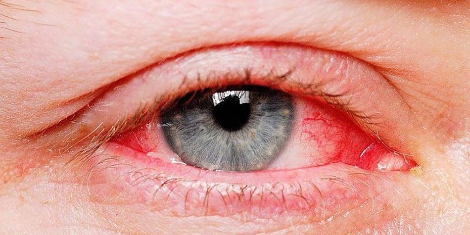 Chứng mắt đỏ là phổ biến, nhưng có thể là dấu hiệu của bệnh nghiêm trọng.