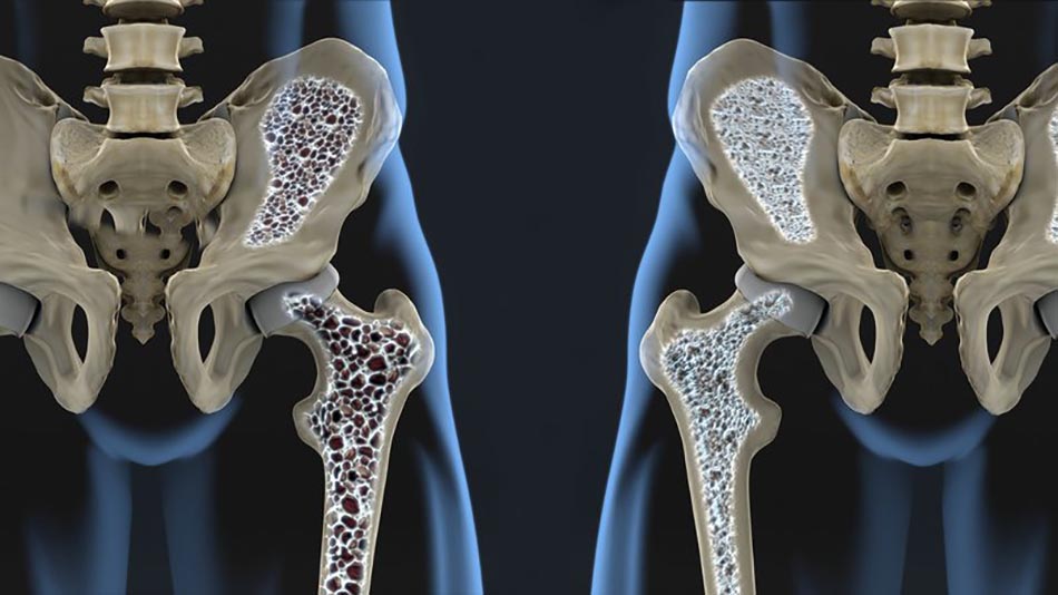 Nghiên cứu mới thay đổi hiểu biết mất xương sau mãn kinh.