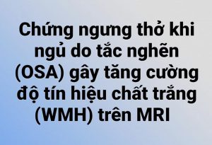 Chứng ngưng thở khi ngủ do tắc nghẽn (OSA) có liên quan đến lượng chất trắng tăng cường (WMH) cao hơn.