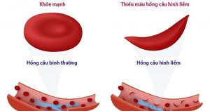 Thiếu máu hồng cầu hình liềm bẩm sinh làm tăng nguy cơ thai chết lưu