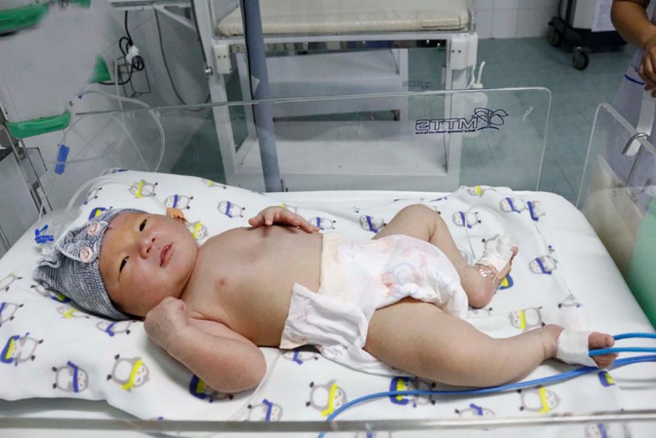 Trẻ sơ sinh có bệnh não thiếu máu do thiếu oxy