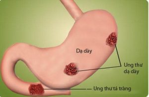 Những bệnh nhân dùng 5-fluorouracil (5-FU) trong điều trị bệnh ung thư đường tiêu hóa có nguy cơ nhồi máu cơ tim