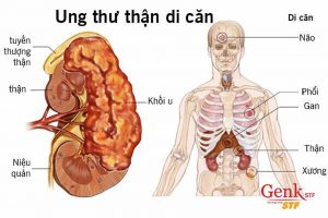 Kết hợp liệu pháp miễn dịch không thành công trong cải thiện khả năng sống sót tổng thể ở bệnh ung thư thận tiến triển