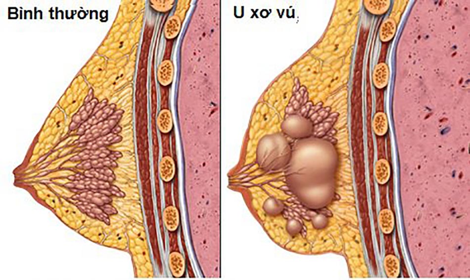 Mật độ tuyến vú có thể làm tăng nguy cơ ung thư tuyến vú ở phụ nữ lớn tuổi.