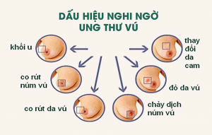 Ước tính đáng tin cậy đầu tiên sự di căn của ung thư vú.