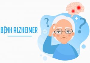 Alzheimer