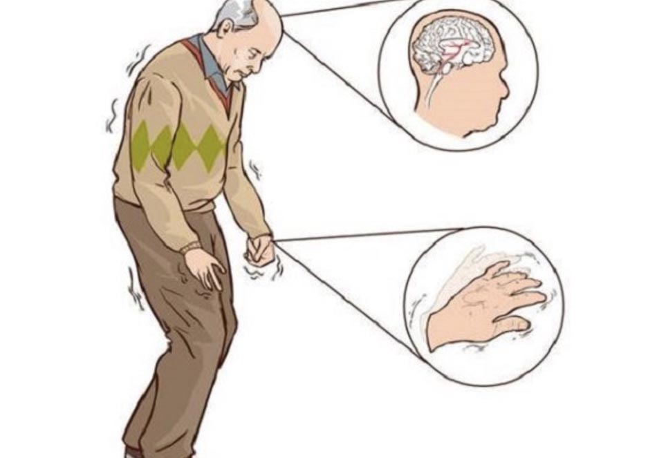 Các triệu chứng không vận động thường gặp ở bệnh Parkinson