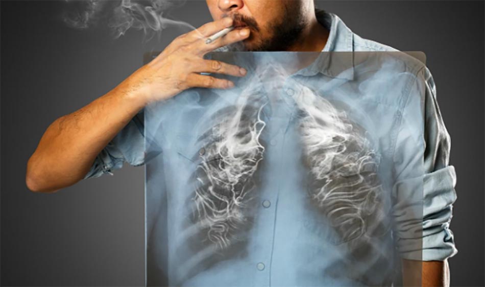 Bỏ thuốc lá có lợi đối với bệnh nhân ung thư nghiện thuốc lá.