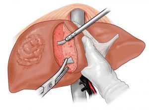 Sử dụng ghép gan của người còn sống đối với bệnh nhân ung thư biểu mô tế bào gan.