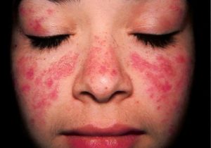 Tiêm vắc xin COVID-19 không làm tăng nguy cơ bùng phát bệnh đối với bệnh nhân có bệnh lupus ban đỏ hệ thống SLE.