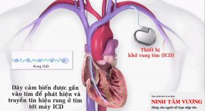 Ngay cả 10 phút tập thể dục hàng ngày cũng có lợi sau khi cấy máy khử rung tim ICD.