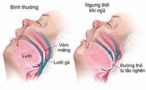 Chứng ngưng thở khi ngủ do tắc nghẽn đang trở nên phổ biến hơn ở trẻ em và thanh thiếu niên