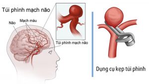 Magiê có liên quan chặt chẽ đến việc giảm nguy cơ chứng phình động mạch nội sọ.