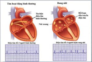 Công việc phải làm vào ban đêm thường xuyên liên quan đến rung tâm nhĩ, bệnh lý tim mạch CHD.