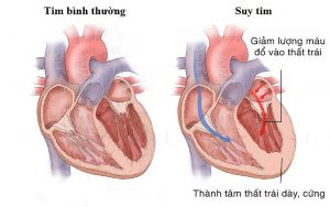 Lợi ích của Iron-Clad của CRT trong việc giảm suy tim do EF