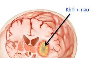 Thêm nhiều trẻ em có u não nguy cơ cao sống sót.