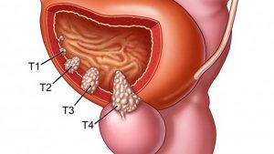 Xét nghiệm phát hiện ctDNA của bệnh nhân trong điều trị ung thư biểu mô bàng quang xâm lấn cơ với liệu pháp miễn dịch