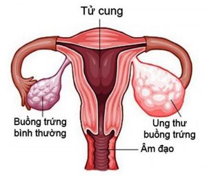 khoảng 30% phụ nữ ung thư buồng trứng biểu mô trải qua xét nghiệm di truyền