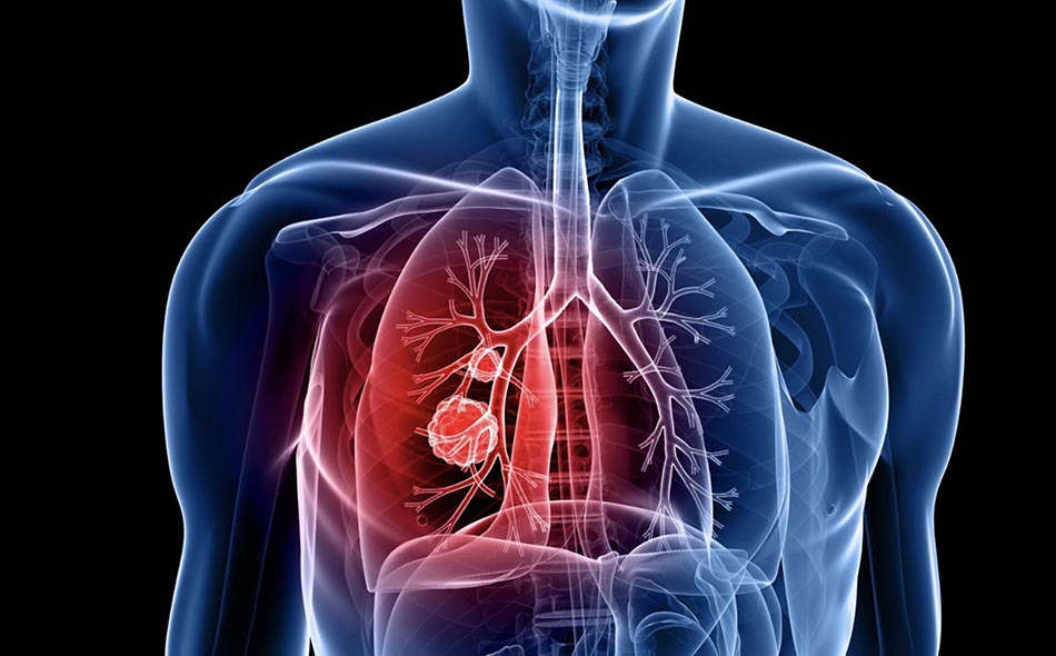 Báo cáo nghiên cứu phát hiện các bất thường phổi kẽ ILA (Interstitial Lung Abnormalities) trên CT scanner.