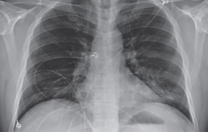 Thông khí không xâm lấn NIV liên quan đến tỷ lệ tử vong cao hơn CPAP trong viêm phổi COVID-19.