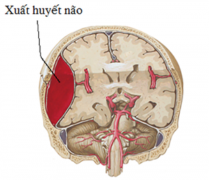 Sự thay đổi huyết áp sớm sau khi có xuất huyết trong não ICH dự đoán tình trạng khuyết tật.